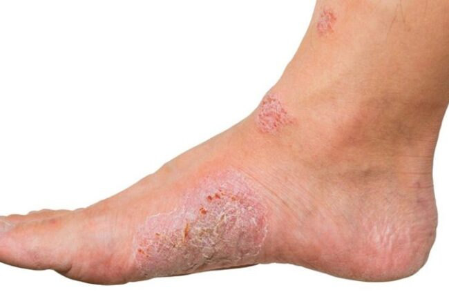 Диабетическая стопа - подолог Долгопрудный