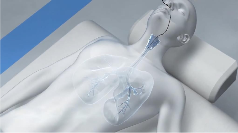 ВИДЕОБРОНХОСКОП MINDSION