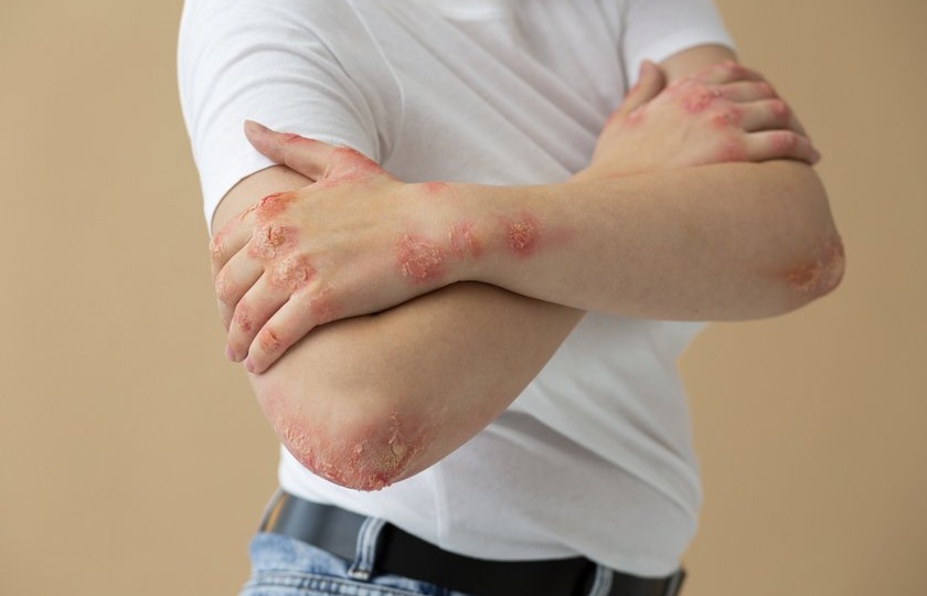 Ученые доказали связь между стрессом и появлением псориаза