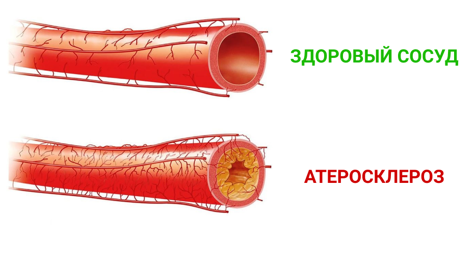 Какой сосуд расширить легче - здоровый или с бляшкой? Ответ очевиден.