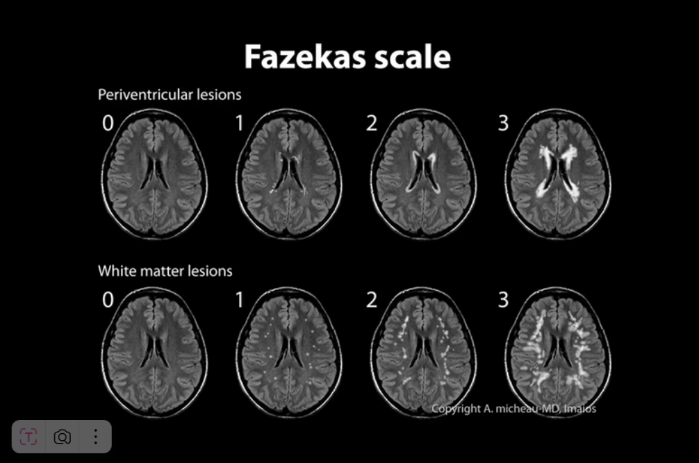 Fazekas grades. Фазекас классификация мрт. Очаги Фазекас мрт. Шкала Фазекас мрт. Церебральная микроангиопатия головного мозга Fazekas 2 степени.