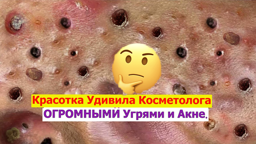 Tải video: Красотка Удивила Косметолога своими ОГРОМНЫМИ Угрями и Акне. Прыщи и Комедоны усыпаны на лице.