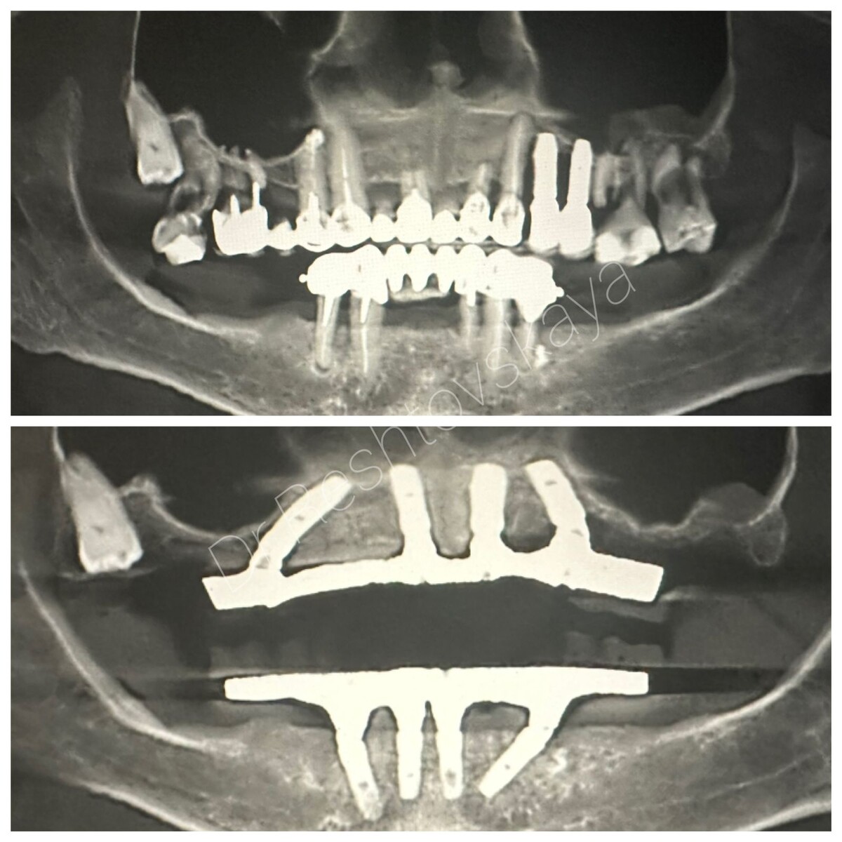 Рентгеновские снимки пациентки до и после лечения. 