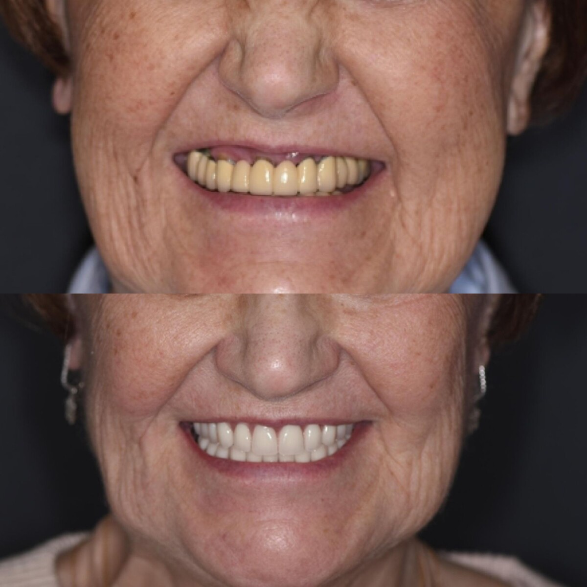 Фото пациентки до и после лечения. 