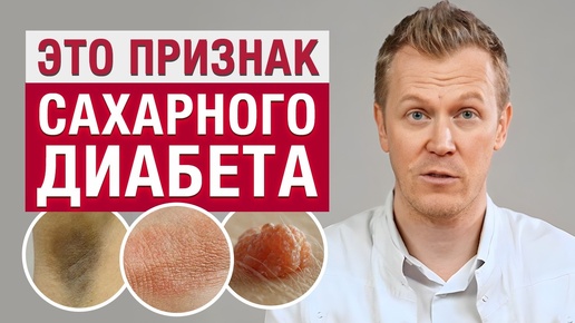 Tải video: Первые признаки сахарного диабета / Как определить уровень сахара в крови по коже?