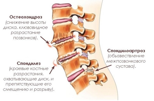 Рис.3 Процессы дегенерации в позвоночно-двигательном сегменте: остеохондроз, спондилез, спондилоартроз