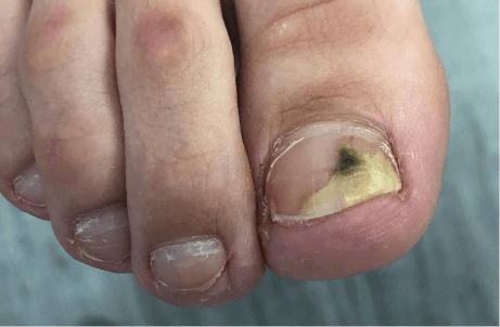 Синегнойная палочка на ногтях