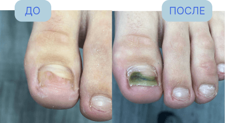 Случай из практики центра подологии "Подоздрав"