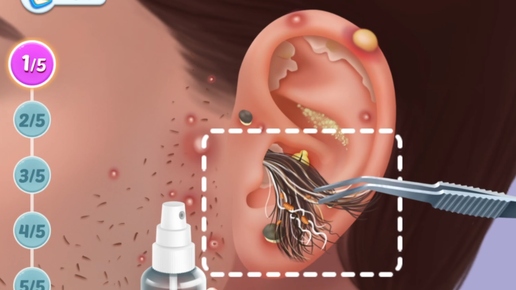 ЛЕЧЕНИЕ УШЕЙ - УШНЫХ ВШЕЙ - ПРЫЩЕЙ И УГРЕЙ - СЕРНЫЕ ПРОБКИ - ЧЁРНЫЕ ТОЧКИ (слабонервным не смотреть)