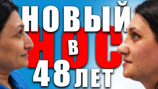 ПОМОЛОДЕЛА НА 10 ЛЕТ / РИНОСЕПТОПЛАСТИКА В МАХАЧКАЛЕ / #ринопластика #пластиканоса #операциянанос