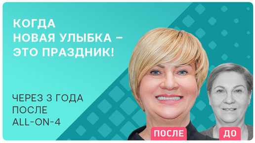 All-on-4: какие ощущения от несъемных протезов на имплантах? Рассказываю!