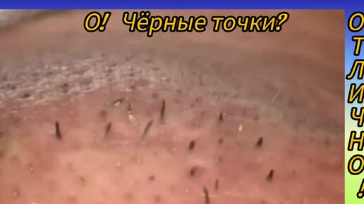 Скачать видео: Угри, как чёрные столбики торчат.