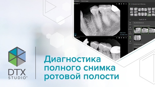 Диагностика полного снимка ротовой полости | DTX Studio Clinic