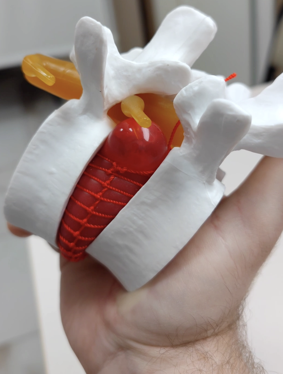 👋 Сегодня расскажу о грыжах межпозвоночных дисков — почему они возникают и как с ними справляться.

На изображении вы видите один из сегментов позвоночника. Межпозвоночный диск, обозначенный красной частью, играет ключевую роль в амортизации нагрузок на позвоночник. Желтые структуры — это корешки спинного мозга, через которые проходят нервные импульсы.

⚠️ Когда диск утрачивает свою эластичность, например, из-за длительных нагрузок, возрастных изменений или резкого движения, возникает выпячивание диска — так образуется грыжа. 

Грыжа начинает давить на нервные корешки, что вызывает неприятные симптомы: боли в руке, ноге, стреляющие боли, онемение и слабость в конечностях. 

Иногда, если повреждение диска небольшое, возникает протрузия — это начальная стадия грыжи, при которой диск лишь немного выпячивается, но ещё не разрывается.

👍 На ранних стадиях грыжа может хорошо поддаваться консервативному лечению. Противовоспалительные препараты и обезболивающая терапия помогают уменьшить боль и воспаление.

💪 Однако ключевую роль в лечении и профилактике играет лечебная гимнастика. 

Регулярные упражнения укрепляют мышцы и связки, которые обеспечивают стабильность позвоночника. Это помогает снизить нагрузку на диск и уменьшить риск компрессии нервных корешков.

Если ваши мышцы и связки в хорошем состоянии, даже при наличии грыжи или протрузии симптомы могут быть минимальными, и вы не почувствуете значительных ограничений в движениях. 

Однако, если мышцы ослаблены, а связки теряют эластичность, боль становится сильнее, движения ограничиваются, могут развиваться серьёзные неврологические нарушения. 

В запущенных случаях грыжа может привести к секвестрации — это процесс, при котором часть диска отмирает, что может серьёзно осложнить лечение.

Поэтому очень важно следить за состоянием позвоночника, избегать резких нагрузок и всегда помнить о пользе гимнастики.  

#Здоровье #Спина #Грыжа #Протрузия #ЛечебнаяГимнастика #БольВСуставах #ЗОЖ #Фитнес #Массаж #Медицина #грыжапозвоночника #протрузия #протрузиядисков #лечениегрыжипозвоночника
