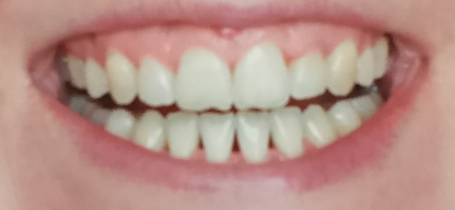 Мои зубы после профессиональной чистки