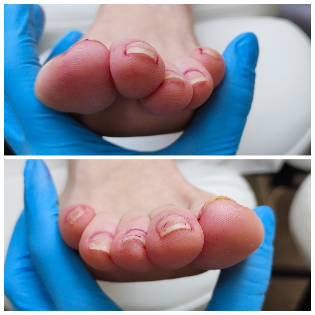 На левой ноге (верхнее фото) второй пальчик поднимается наверх, большой пальчик начинается прятаться под второй. Мизинчик прилег на четвертый палец.
На правой ноге мизинчик присаживается сверху на четвертый палец, т.к. в обуви ему не хватает места. 