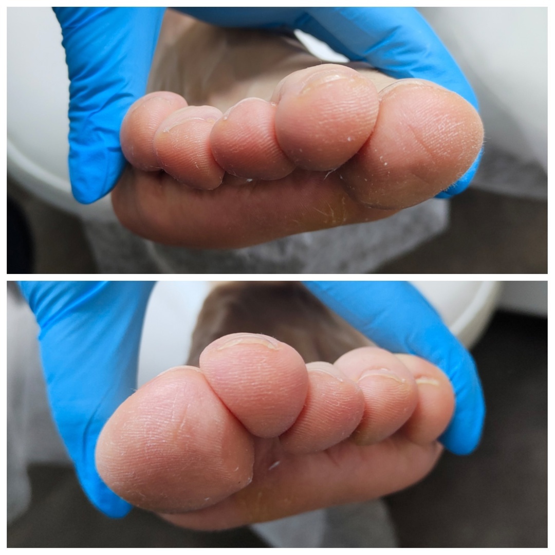 На обоих ногах второй пальчик выдавливается наверх. В перспективе это пальцы "наездники", когда второй палец полностью лежит на третьем. На верхнем фото мизинчик поднимается над четвертым пальцем, т.к. ему не хватает места в обуви.