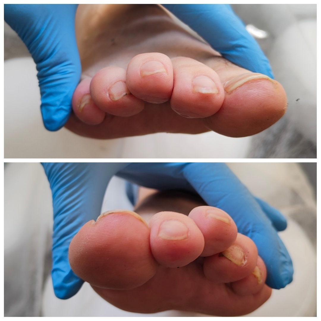 На правой ноге (верхнее фото) третий палец начинает подниматься выше второго, т.к. его выжимают мизинчик и четвертый палец.
На левой ноге третий палец еще сильнее, чем на правой ноге поднялся вверх.
На обоих ногах второй палец загибается вниз, это связано с тем, что он длиннее, чем большой, а обувь в данном случае подбирают по длине большого пальца.