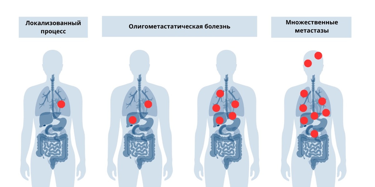 На этом рисунке (слева направо): локализованный процесс, когда есть только первичная опухоль; олигометастатическая болезнь с одним метастазом; олигометастатическая болезнь с четырьмя метастазами; распространенный метастатический рак.