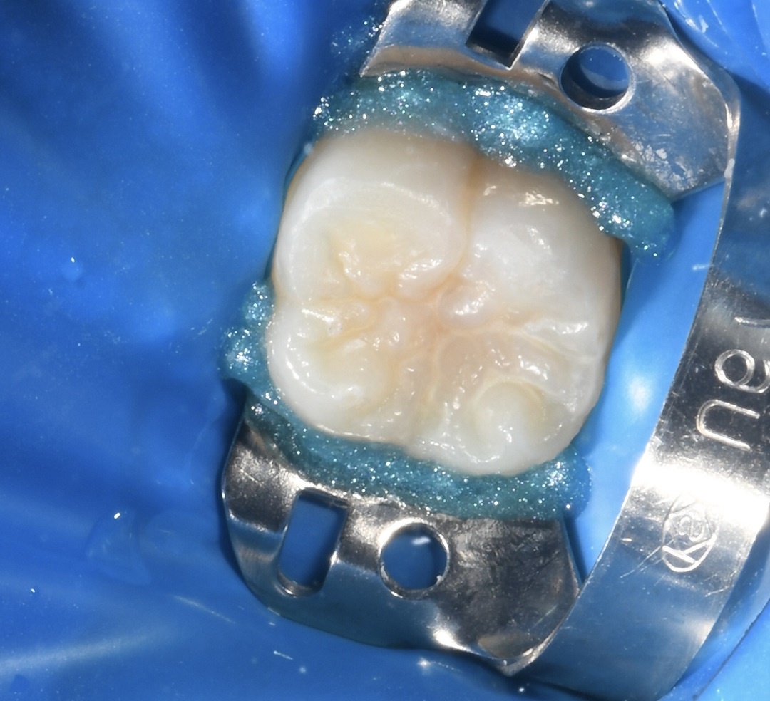 До герметизации