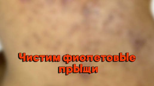 Чистим кожу от УГРЕЙ и собираем их на перчатку