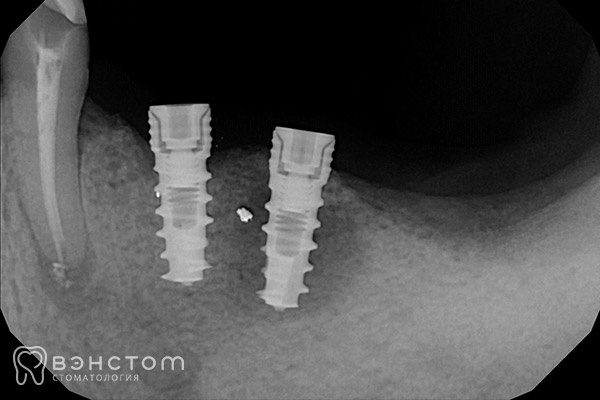На рентгене заметно потемнение вокруг одного из имплантов, оно свидетельствует о патологическом процессе.
