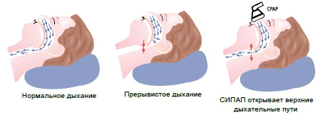 CPAP-терапия 
