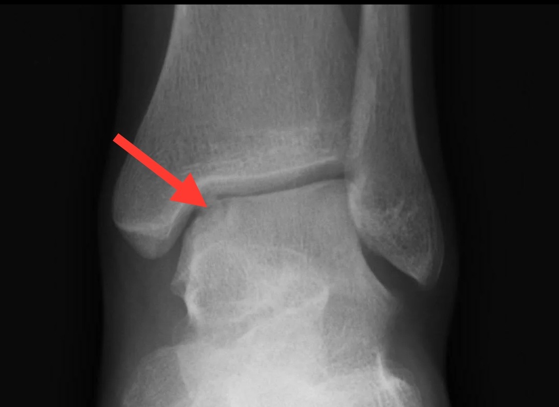 Рассекающий остеохондрит кёнига. Некроз таранной кости мрт. Остеохондральное повреждение таранной кости. Рассекающий остеохондрит пяточной кости. Остеохондральное повреждение таранной кости.