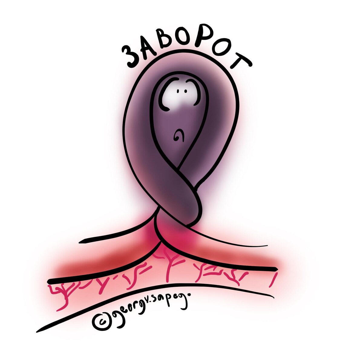 Заворот кишок