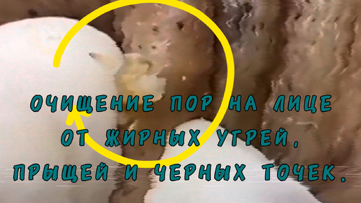 Очищение пор на лице от жирных угрей и прыщей.