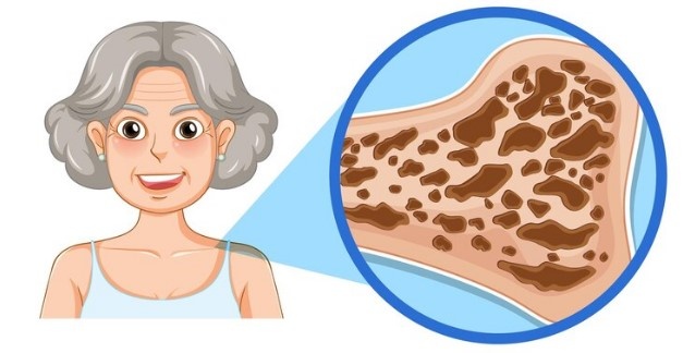 Снижение плотности костей - признак остеопороза