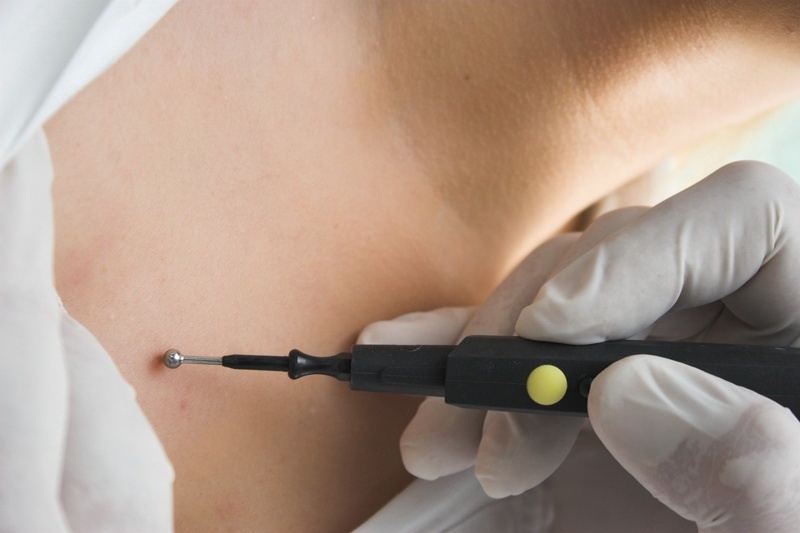 Радиоволновым методом что это. Электрокоагуляция фотек. Радиоволновой скальпель сургитрон. Радиоволновая деструкция. Радиоволновым методом что это.