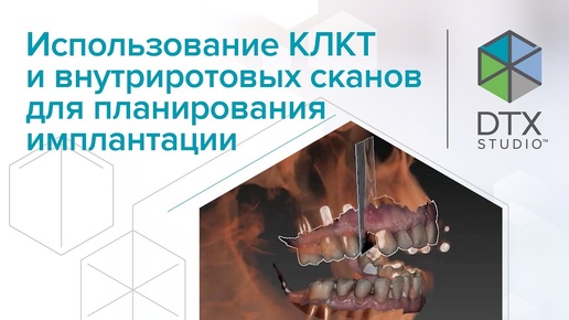 Использование КЛКТ и внутриротовых сканов для планирования имплантации | DTX Studio Clinic