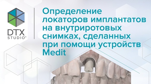 Определение локаторов имплантатов на внутриротовых снимках, сделанных при помощи устройств Medit