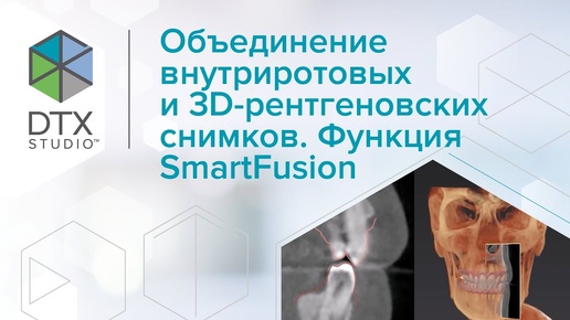 Объединение внутриротовых и 3D-рентгеновских снимков Функция SmartFusion | DTX Studio Clinic