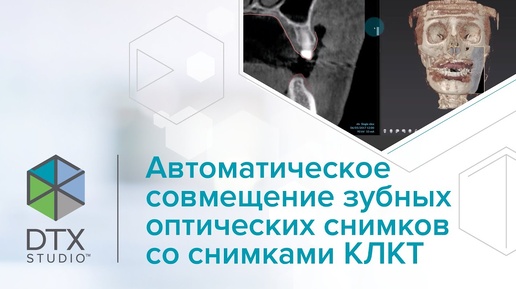 Автоматическое совмещение зубных оптических снимков со снимками КЛКТ | DTX Studio Clinic