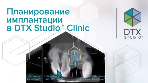 Планирование имплантации в DTX Studio Clinic