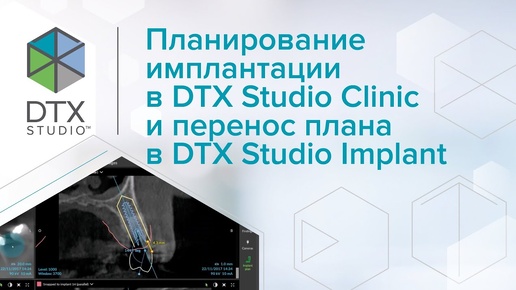 Планирование имплантации в DTX Studio Clinic и перенос плана в DTX Studio Implant