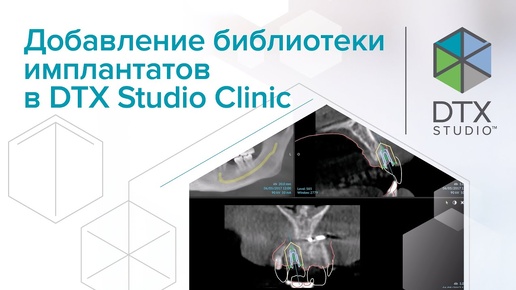 Добавление библиотеки имплантатов в DTX Studio Clinic