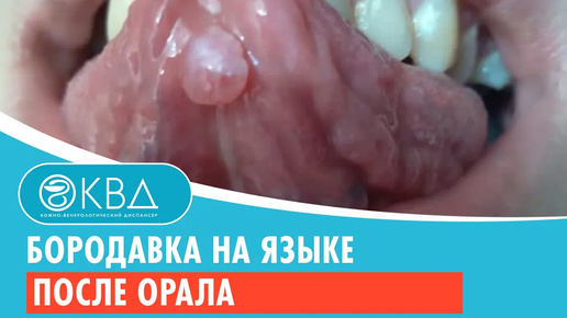 👅 Бородавка на языке после орала