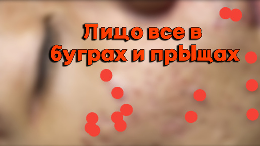 Иголочкой всковырнули все мелкие и крупные прыщи