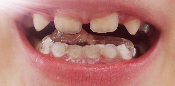 Накладка на зубы для исправления прикуса, прозрачная