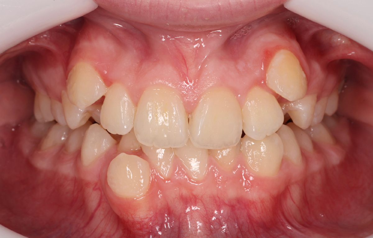 Вестибулярное положение клыков - через месяц-два уже увидим приличный результат