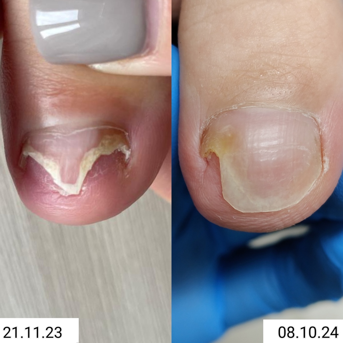 Фото 2. Динамика лечения ногтя от грибка фузариума