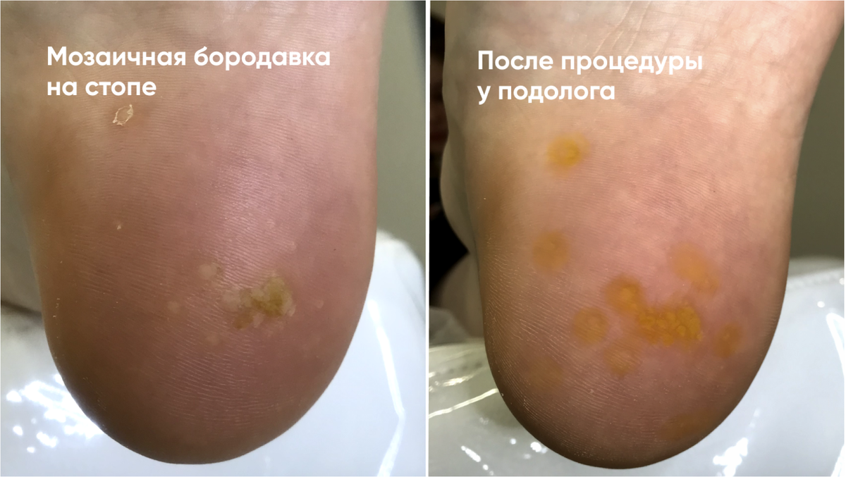 Пример удаления мозаичной бородавки на стопе: до и после