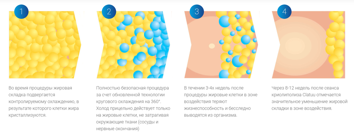 Как работает криолиполиз на аппарате Clatuu | Источник - https://clatuu.pro/