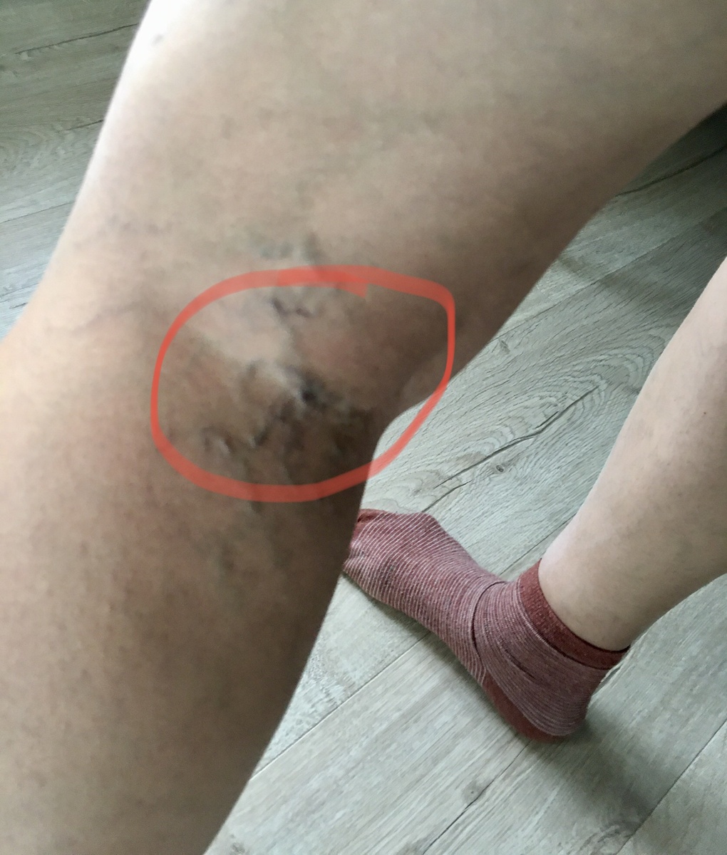 Страшные вены. 