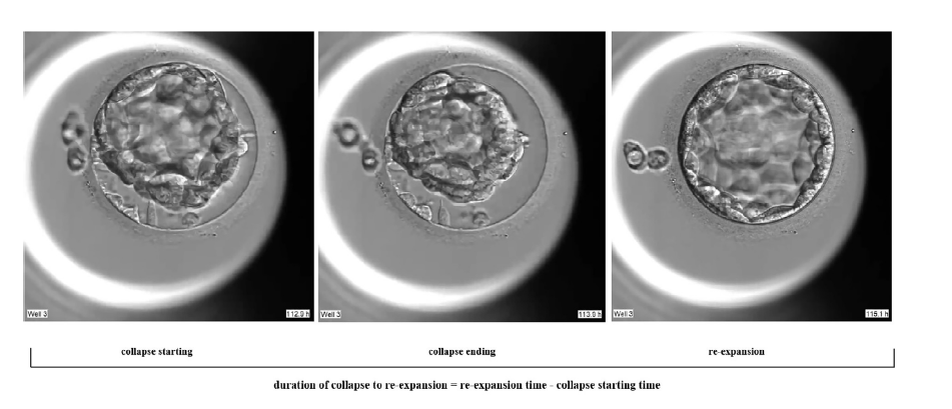 рис1. Определение продолжительности коллапсирования до повторного раскрытия. Спонтанное коллапсирование было определен как явление, при котором поверхность трофэктодермы отделяется от zona pellucida с процентом разделения >50%. Продолжительность спонтанного коллапсирования была определена как период от начала коллапсирования до тех пор, пока все клетки трофэктодермы не будут снова в контакте с zona pellucida бластоцисты. Формула для продолжительности коллапсирования до повторного расширения — это время повторного расширения минус время начала коллапса. На изображенном примере показана продолжительность коллапса до повторного расширения: 2,2 ч.
