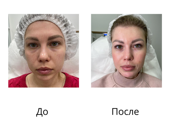 Пациентке клиники COSMOPRO была проведена процедура: Ботулинотерапия “FullFace” (Диспорт),  а также коррекция средней трети лица (Radiesse) и коррекция подбородка (Belotero Volume). Процедуру выполнила врач-дерматовенеролог: Магомедова Пасихат, основательница сети клиник COSMOPRO.