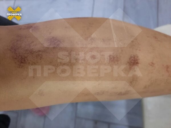 Девушка получила 40% после лазерной эпиляции. Фото © SHOT ПРОВЕРКА